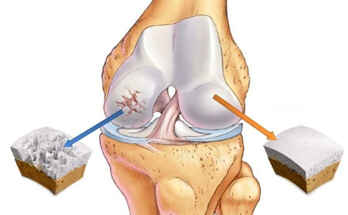 healthy cartilage and knee arthrosis