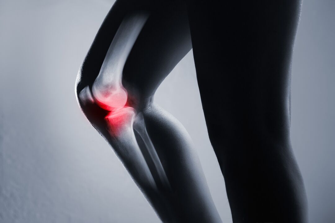 knee joint inflammation with arthrosis