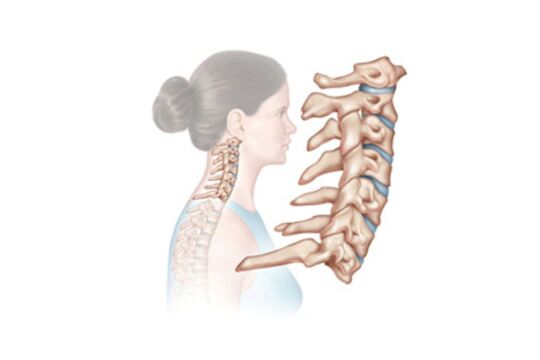 cervical spine damage with osteochondrosis