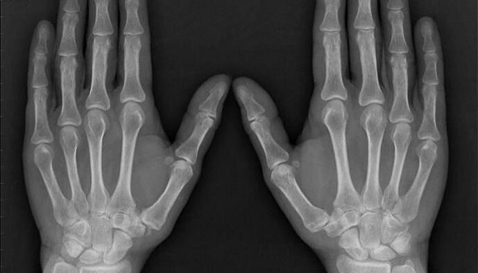 x-ray for the diagnosis of arthritis and osteoarthritis