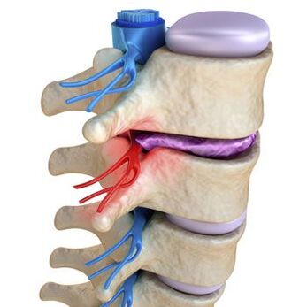A pinched nerve in the spine is accompanied by sharp pain