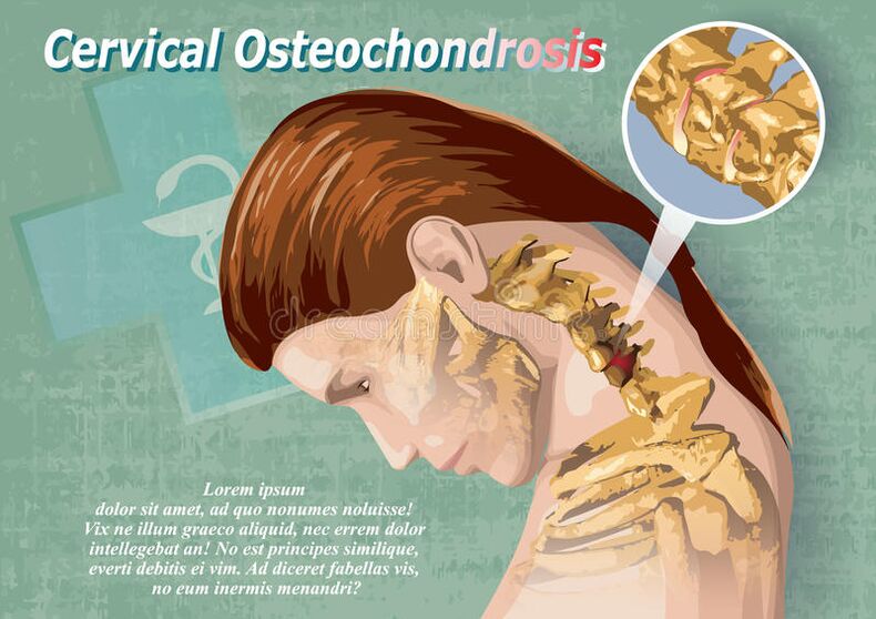 Cervical osteochondrosis is a disease of cartilaginous tissue