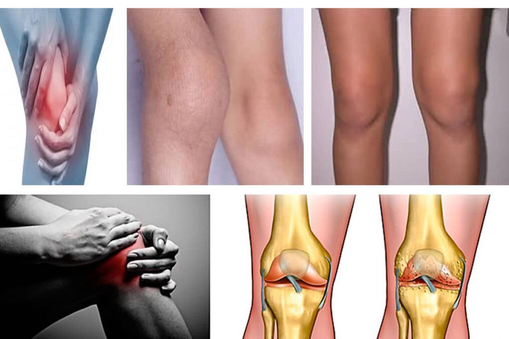 knee osteoarthritis symptoms